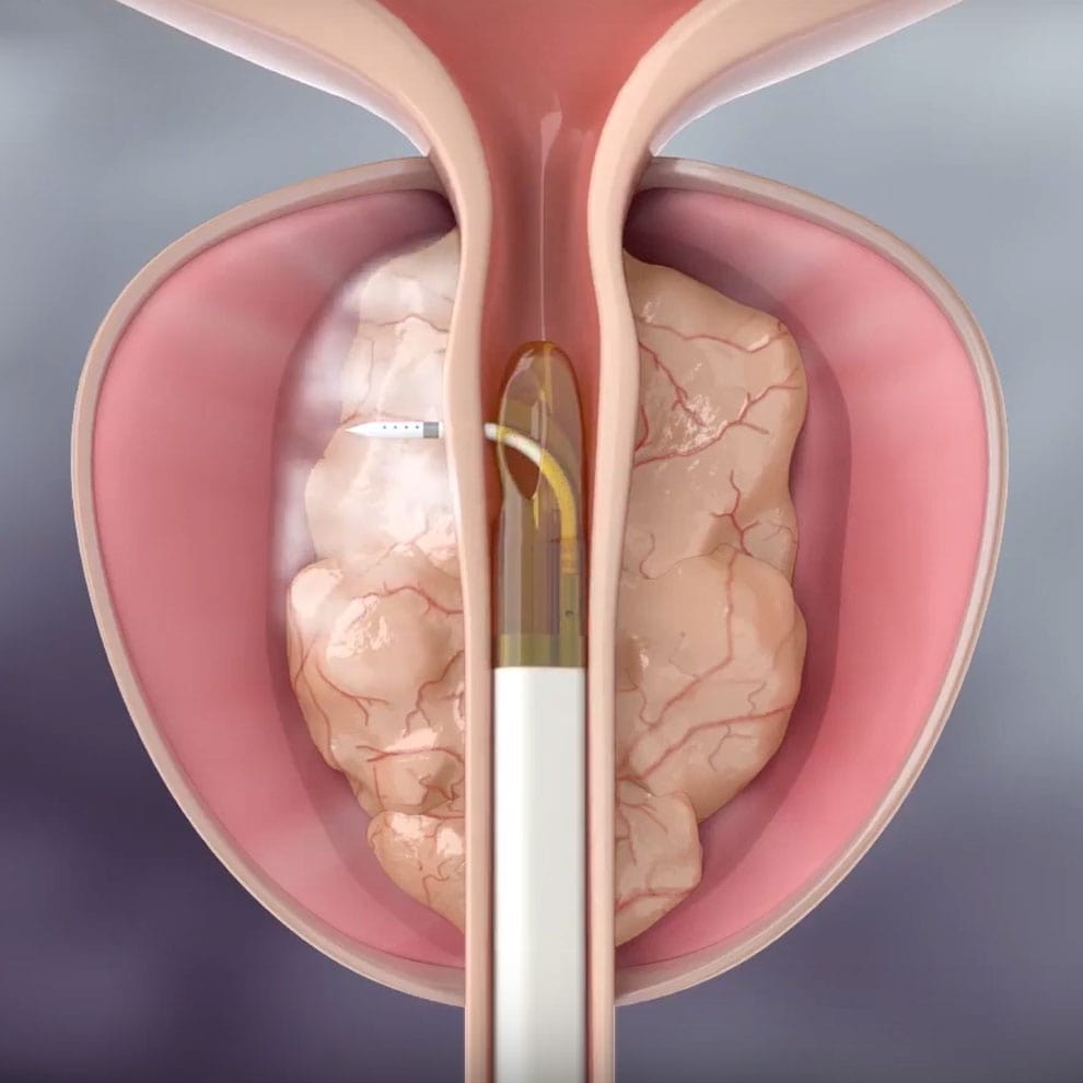 Rezum Therapy