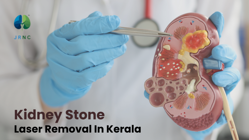 kidney stone laser removal in kerala