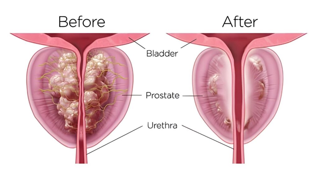 Rezum before and after results in dubai