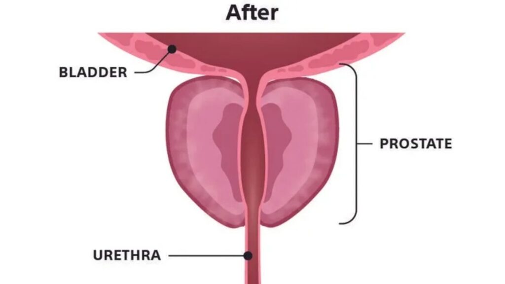 Rezum treatment risks and side effects in dubai