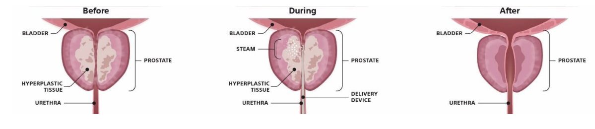 Risks of Rezum therapy and possible side effects